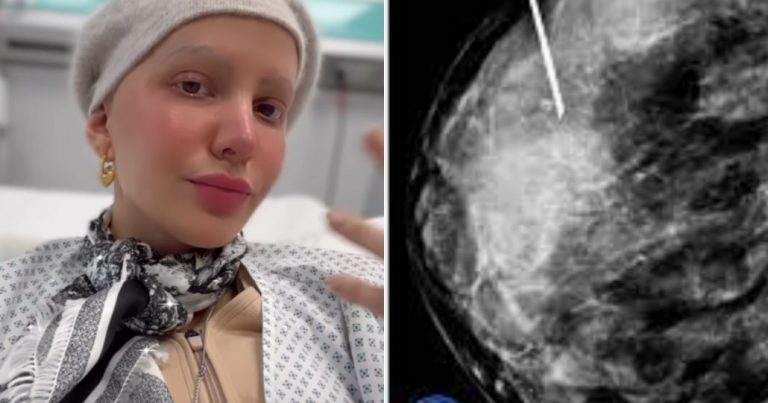 «Me dolió mucho»: Aylén Milla relató su último procedimiento médico por el cáncer de mama